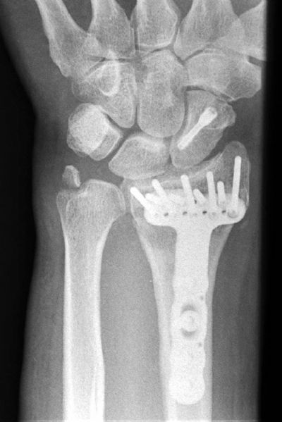 Radius, Distal:  Hand Innovations DVR Plate (Implant 344)
